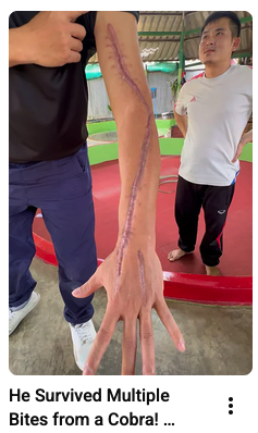 realMR5150's tweet photo. @Duran876905 @EnVeritas23 A Youtuber who handles snakes had one and got bit...he got to hospital in minutes and got the antivenom and was in hospital for about a month and now has life long venom scarring on his hand and arm...looked really bad.
https://t.co/GnzD09QtAw https://t.co/7LrkjjcwhK