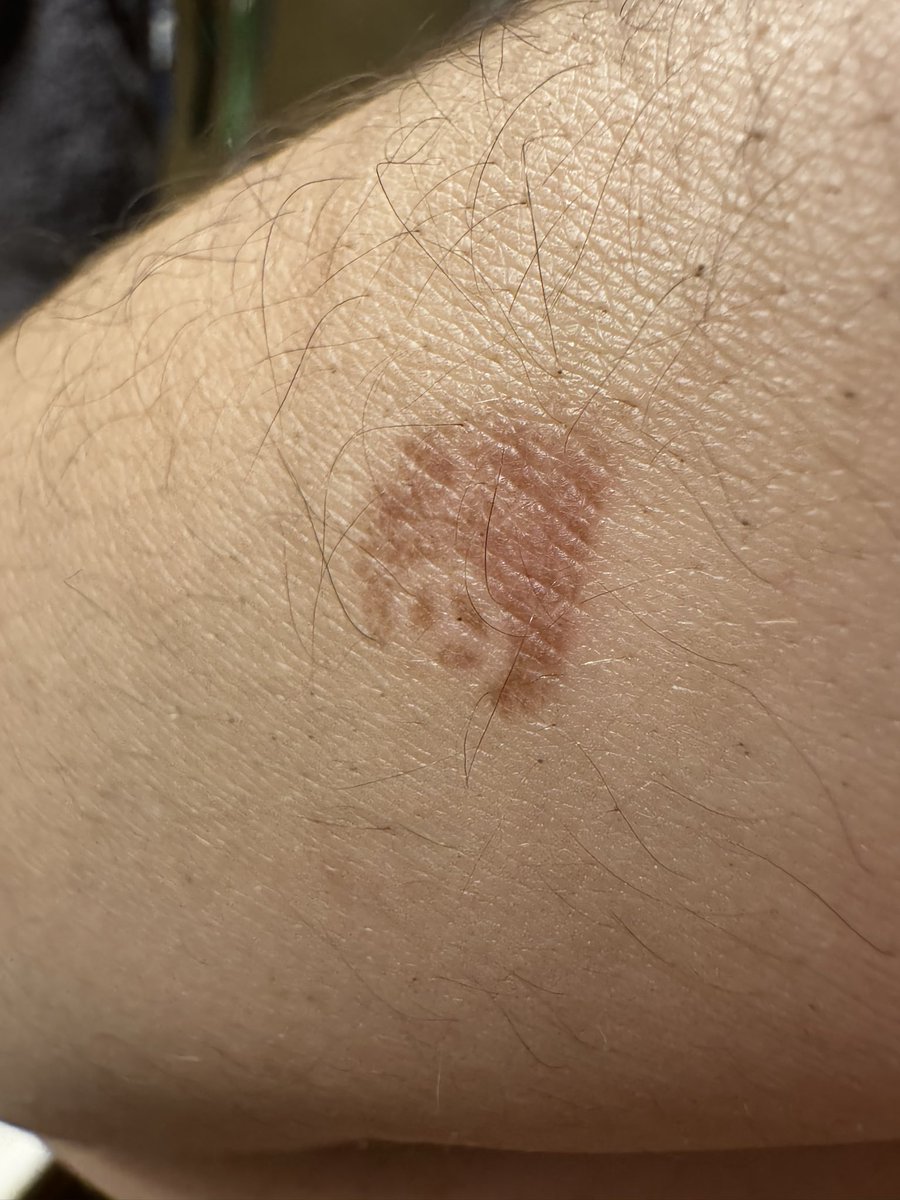 romcommulus's tweet photo. no way i burned the benz logo into my forearm from a cat https://t.co/jU0PZlt5iF