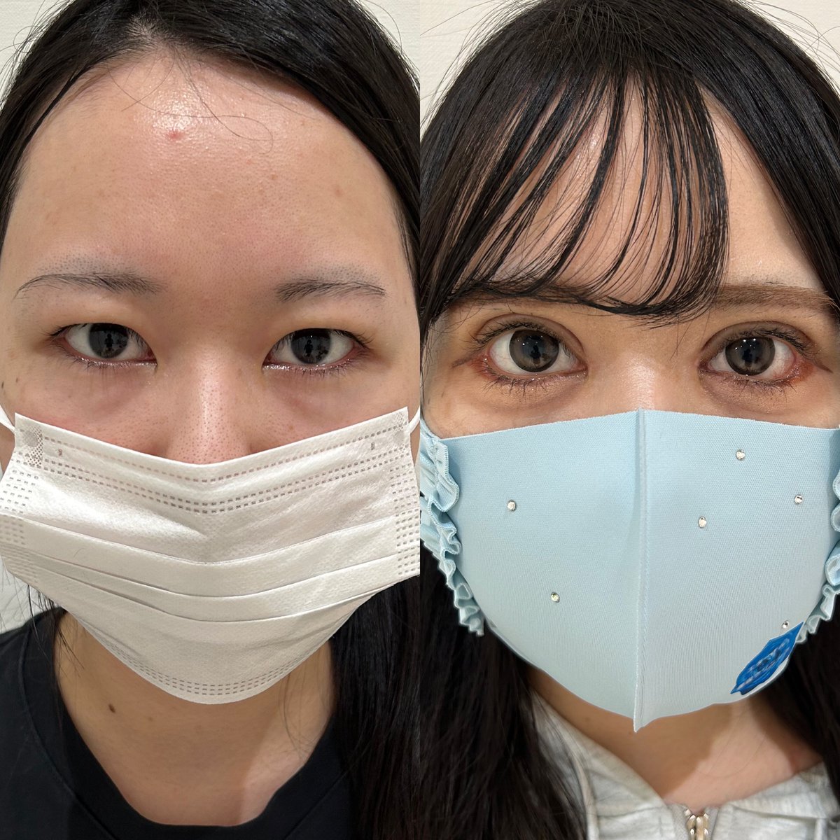 eternalprince08's tweet photo. 全方向目拡大症例

劇的に、可能な限り目を大きくしたいご希望で、全方向目切開を行いました

#エターナルクリニック
#全方向目切開
#たれ目形成 https://t.co/PQYiz7Uow5
