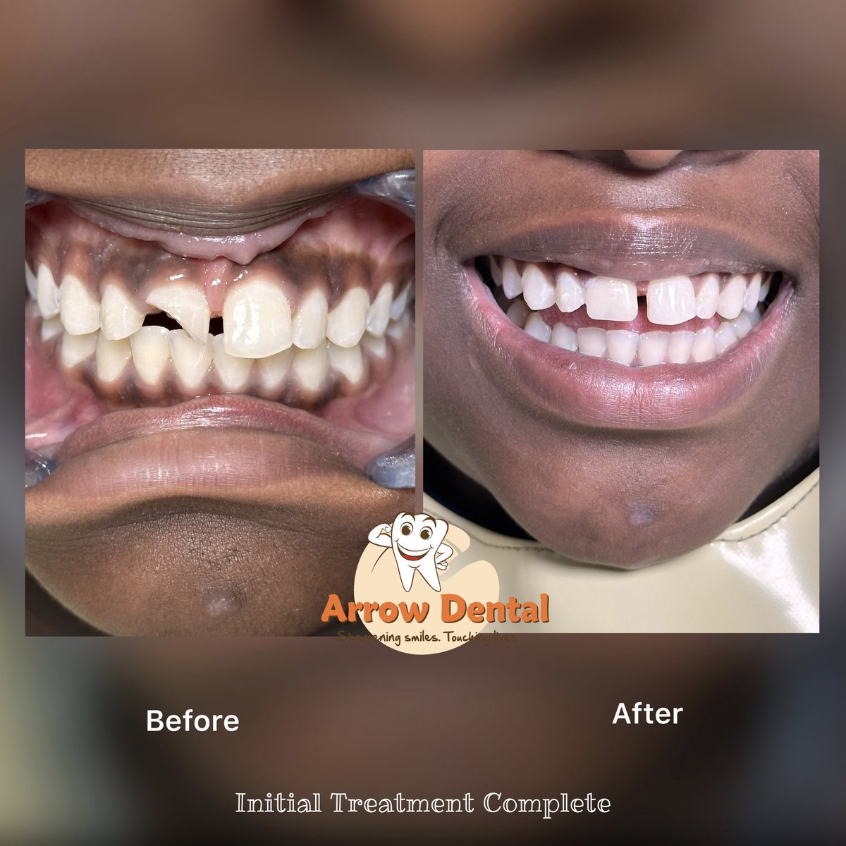 Arrow_Dental's tweet photo. Day One ✅
Root canal treatment completed in one stage, followed by an initial composite filling.

Next up: a zirconia crown for the definitive finish. ✨

Got a dental emergency? Talk to us today.

📲 0119384741 | 0740187579

#arrowdental 

#ArrowDentalWorldChampions
Kenya’s Dental Pride