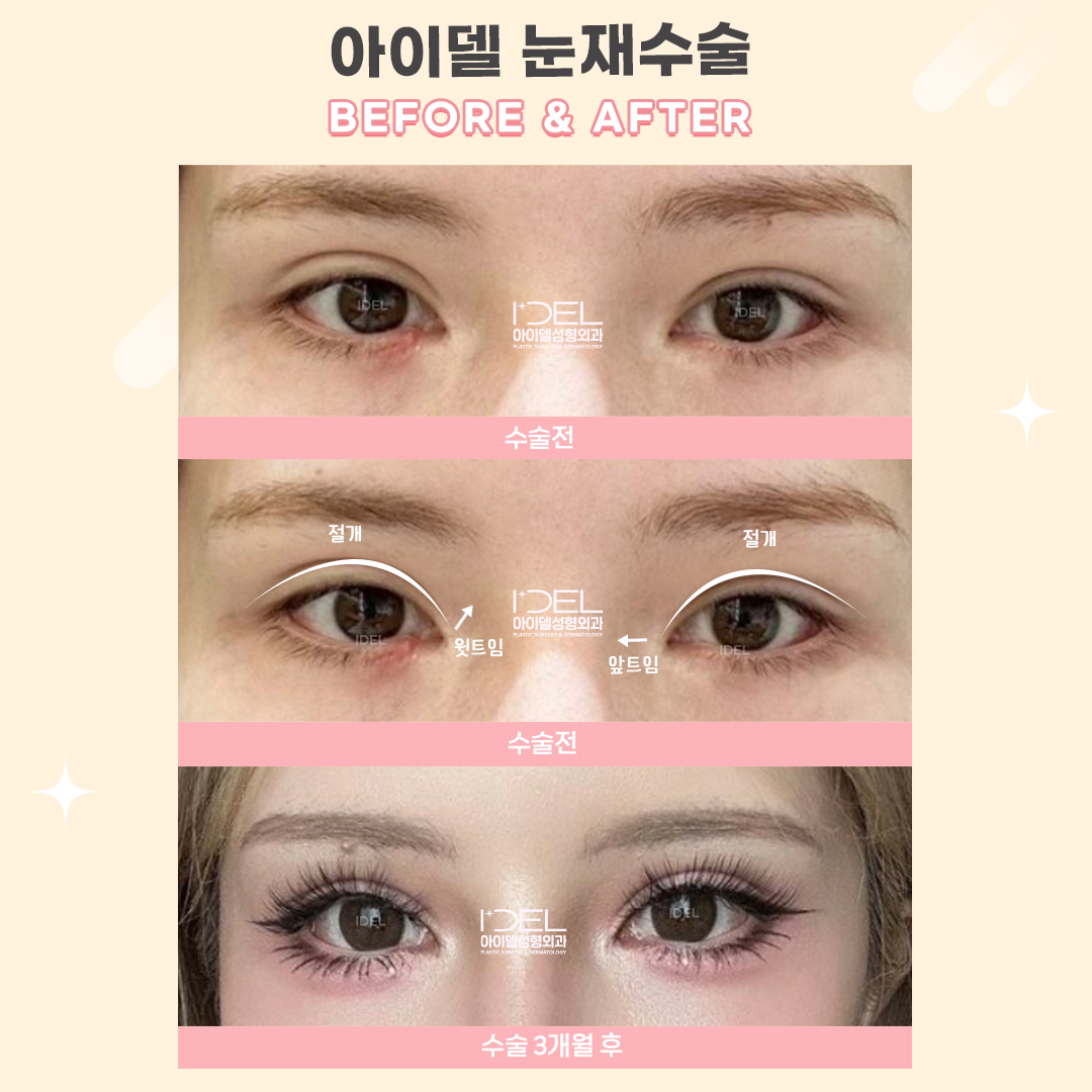 idelprs_kr's tweet photo. 아이델에서 [절개 ��수술, 앞트임, 윗트임 3개월차] 된 고객님의 후기예요 😊

#자연유착 #눈재수술 #アイデル美容外科 https://t.co/rfBtcWM7BM