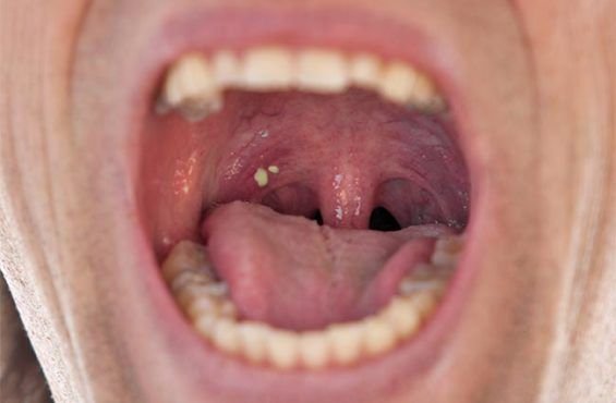 darlaqueendom's tweet photo. My cousin coughed 2-3 times today and these things came out of his mouth.When he looked in the mirror he saw more two towards the throat.Can someone tell us what is this please!!! https://t.co/lOlVOxnwBY