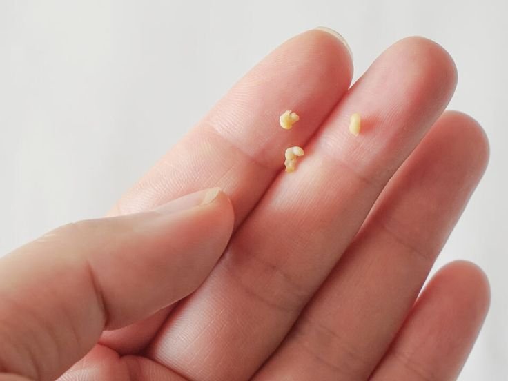 darlaqueendom's tweet photo. My cousin coughed 2-3 times today and these things came out of his mouth.When he looked in the mirror he saw more two towards the throat.Can someone tell us what is this please!!! https://t.co/lOlVOxnwBY