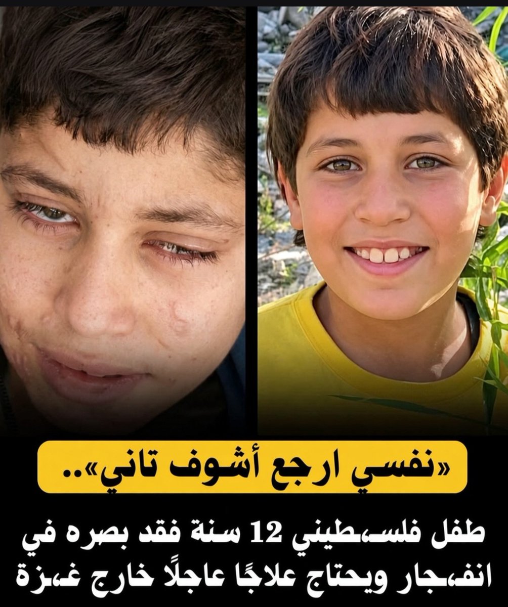 ABO_Watan9's tweet photo. "نفسي أرجع أشوف تاني"

إبراهيم، طفل فلسطيني 12 عامًا، فقد بصره وأصيب بجروح بالغة إثر انفجار.

يحتاج علاجًا عاجلًا وعمليات متخصصة خارج غزة لاستعادة بصره.

ساعدوا إبراهيم ليعود إلى طفولته. https://t.co/MP0LJjIlJV
