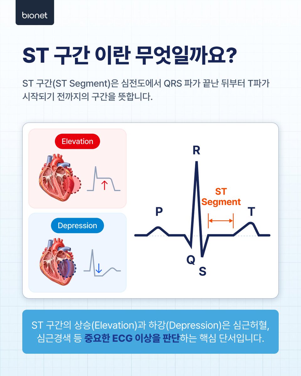 BionetHQ's tweet photo. ST 변화를 한눈에 🔍
바이오넷 ECG의 ST Map은 ST 상승·하강과 변화의 분포를 원형 맵으로 보여주어 의료진의 심전도 해석을 돕습니다.

미국 특허 US 11,553,868 B2

※ ST Map은 진단을 내리는 기능이 아닌 해석 보조 도구입니다.

#Bionet #STMap #ECG https://t.co/z96Cmd8StR