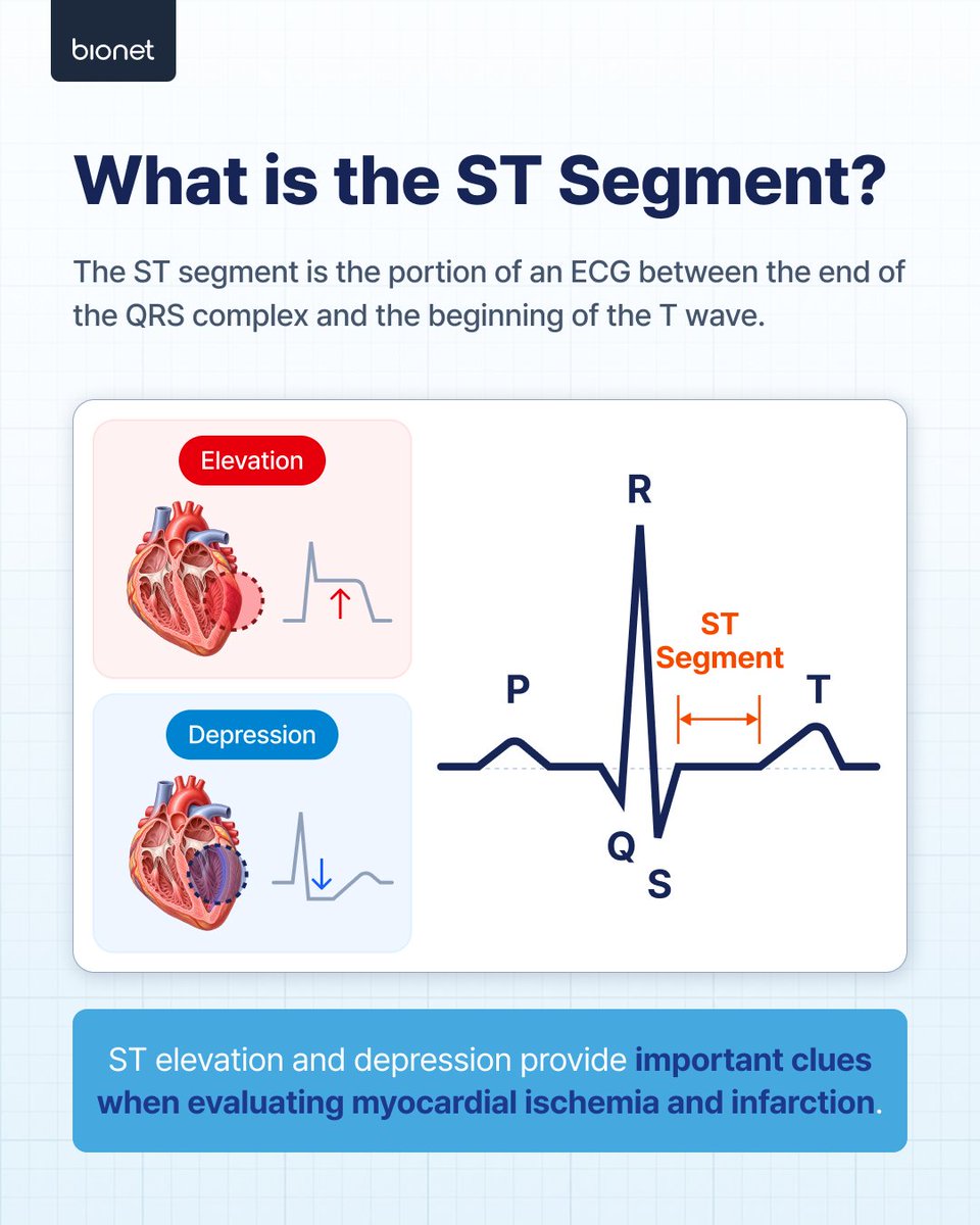 BionetHQ's tweet photo. ST changes at a glance 🔍
Bionet’s ECG ST Map visualizes ST elevation and depression in a circular display to support ECG interpretation.

U.S. Patent 11,553,868 B2

For interpretation support—not a standalone diagnosis.

#Bionet #STMap #ECG https://t.co/AYv77mS5Uc