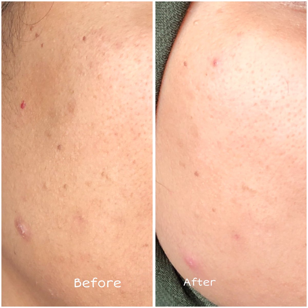 manaaaasi's tweet photo. dulu kalo ada jerawat 1 aja langsung insecure seharian😢

sekarang ngerti cara bikin si acne monster ini GAME OVER👋🏻 https://t.co/SAqhSn9mPA