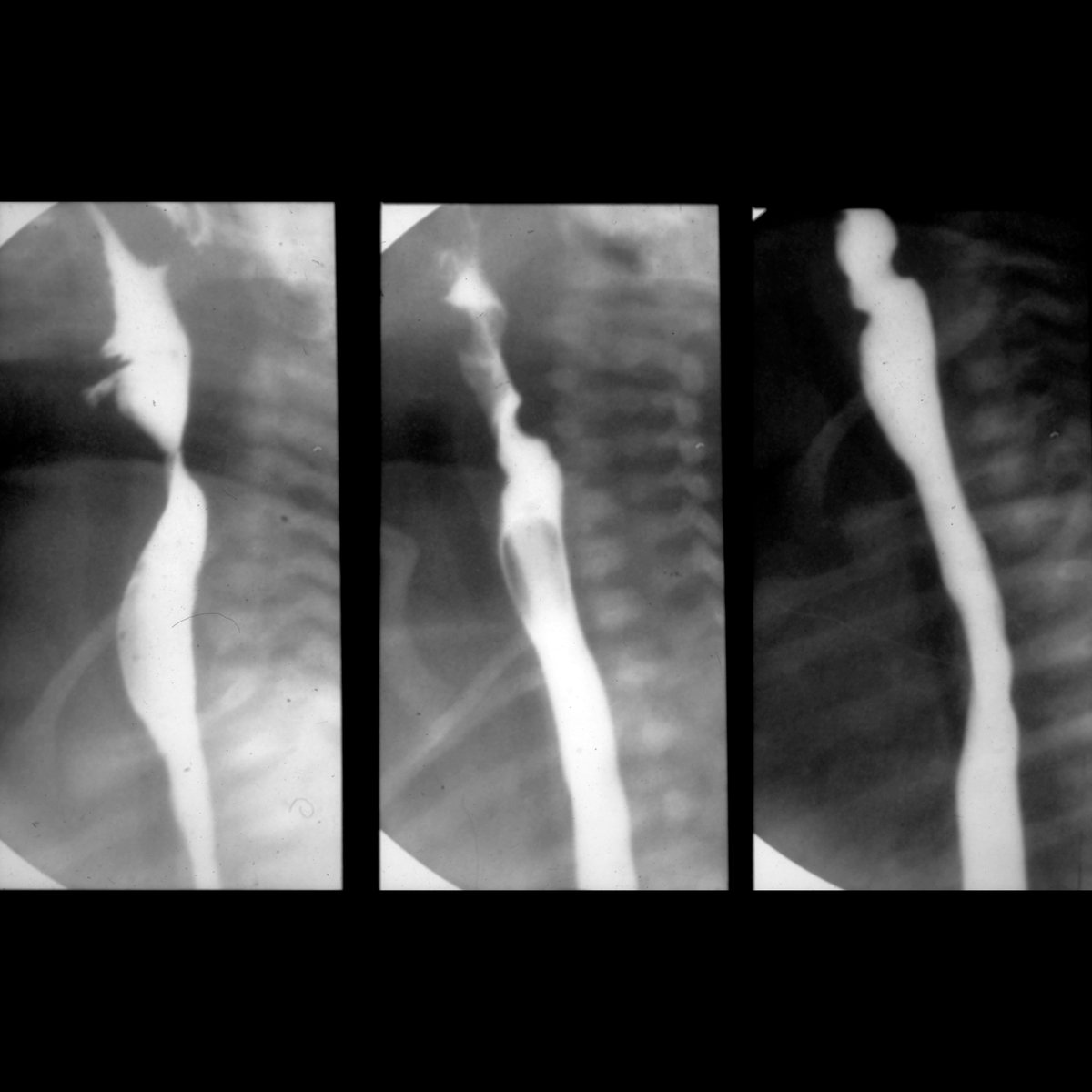 pedsimaging's tweet photo. Newborn with vomiting
Serial lateral images from upper GI show normal caliber of esophagus with no extrinsic compressions on it. The esophageal mucosa is normal in appearance.
#FOAMed #MedEd #FOAMRad #PedsRad #RadEd #RadRes #radiology #pediatrics #radiologia #radiologie https://t.co/ElFcQvte7a