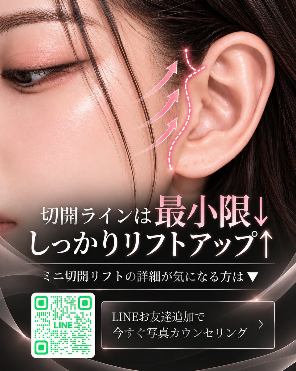 POPJapanPS's tweet photo. 糸リフトじゃ物足りない。でもフル切開はまだ怖い。
その「間」が欲しい人、ミニ切開リフト見て。🫧

フェイスラインのたるみ、切開ライン、SMAS層。
気になるとこだけ3枚でサクッとまとめた。

傷跡・ダウンタイムの相談はLINEへ🪽
@139jiocx
※画像はAI生成のイメージです。 https://t.co/eaMIAKtgdN