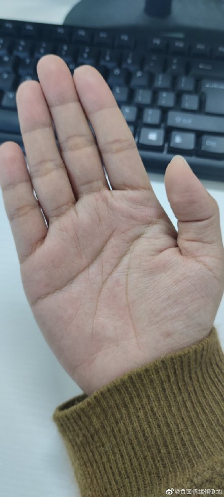 EliaChevisrltk's tweet photo. Cada cicatriz en mi mano es una lección que me ayudó a caminar más seguro, no me avergüenzo de ellas, son parte de mi camino. https://t.co/KfhLqZgcAO