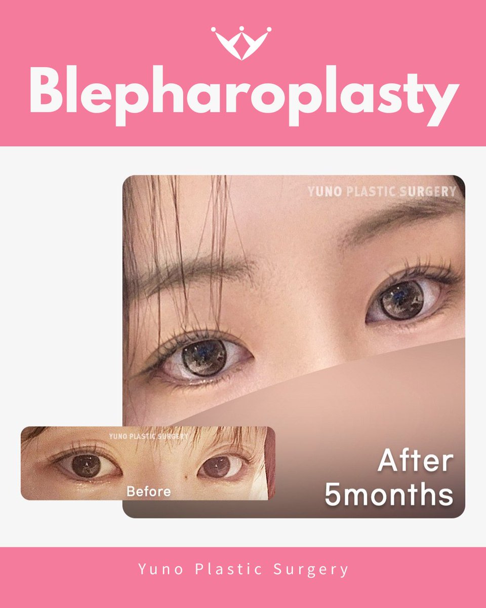 yuno_eng's tweet photo. ✨ Blepharoplasty at YUNO ✨
Refresh and refine your eyes with a personalized approach designed to create a natural and harmonious look. 👁️
📍 Seoul, Korea
💬 KakaoTalk: yuno_ps
📱 WhatsApp: +82 10 2257 8670
Only at YUNO Clinic.
#YUNOClinic #Blepharoplasty https://t.co/NtboWaxyUi