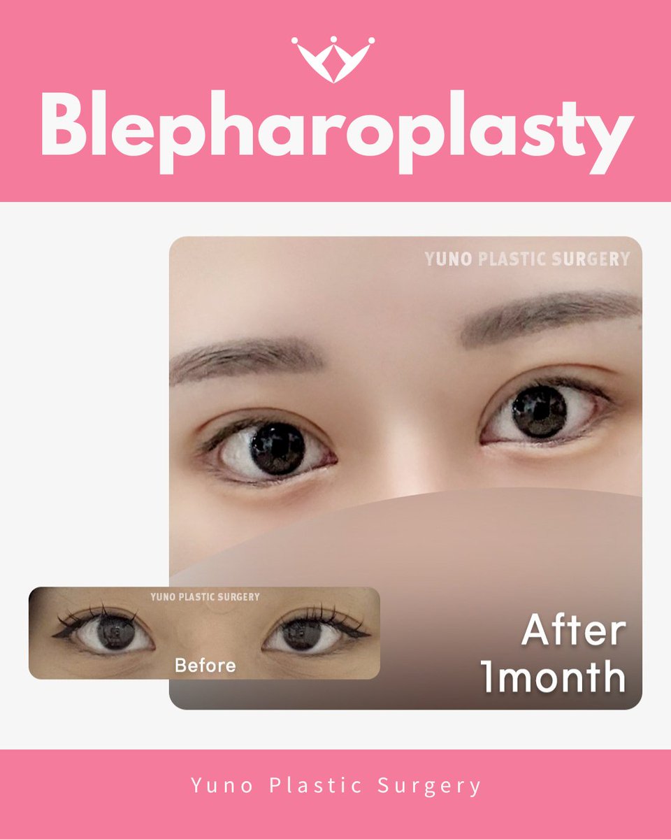 yuno_eng's tweet photo. ✨ Blepharoplasty at YUNO ✨
Refresh and refine your eyes with a personalized approach designed to create a natural and harmonious look. 👁️
📍 Seoul, Korea
💬 KakaoTalk: yuno_ps
📱 WhatsApp: +82 10 2257 8670
Only at YUNO Clinic.
#YUNOClinic #Blepharoplasty https://t.co/NtboWaxyUi