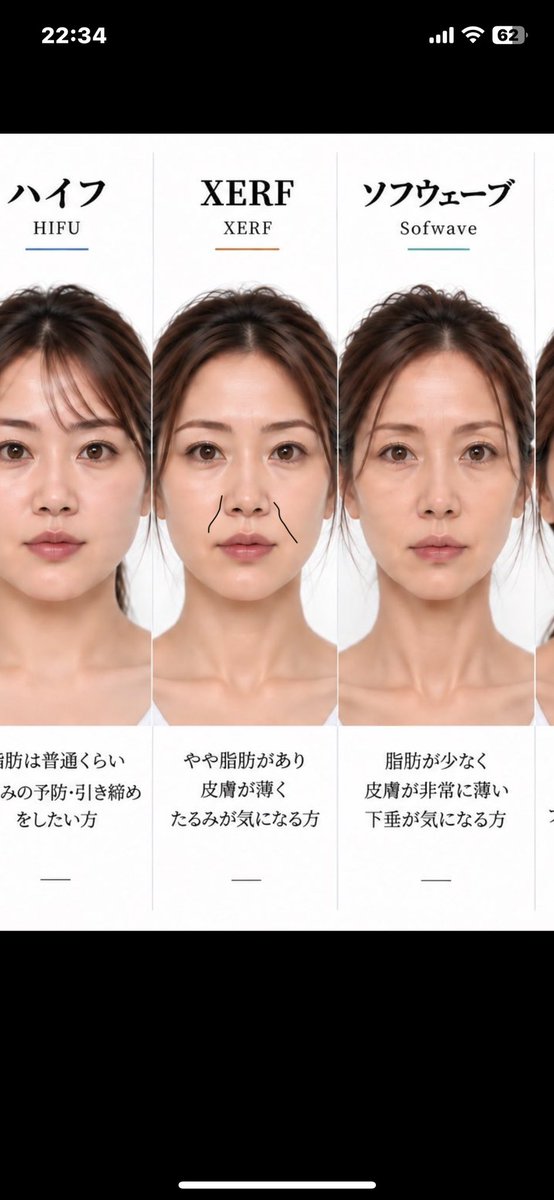 complexarasa's tweet photo. ワイマジでザーフほうれい線顔だったな。
元画像にもうさらに脂肪が乗って貴族〜ほうれい線までしっかり線が入ってる感じ。

だから多分ザーフだけやっても効果なく、ほうれい線上にフォーカスしてインモード→ザーフだったら効果あったんだろうな。 https://t.co/Aa4gSCwIpb