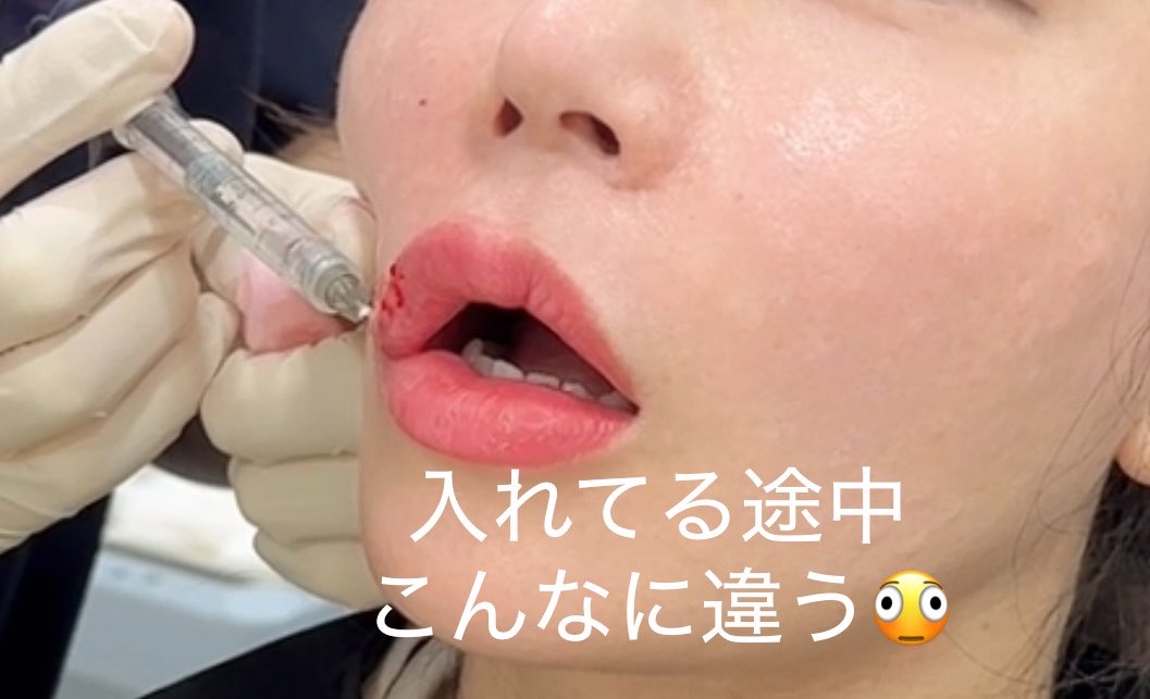昨日感動して載せたリップフィラーのクリニックは@newstar_jp です😍ロシアンリップ的な上に上がるクルッとした唇にして！ってオーダーしました🥰まだ腫れてるけど仕上がり楽しみだなぁ♡クリニックがバリスタも居るマジでおしゃれカフェで待つのが全く苦にならない😆 https://t.co/IFf3VJ52fk