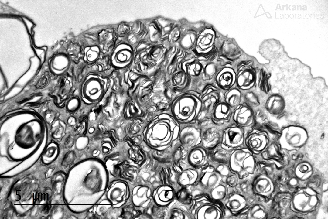 arkanalabs's tweet photo. This photomicrograph of a Jones silver stain is interesting in that it shows two findings. First, at 10 o’clock an area of hyalinosis at the perihilar region is present and compatible with perihilar focal segmental glomerulosclerosis. However, if you look closely you will notice that the podocyte cell bodies are very large and vacuolated. This finding is uncommon and is typically seen in the setting of Fabry disease (and usually very difficult to appreciate, unlike in this example). And, while myeloid bodies can be seen in patients on chloroquine or hydroxychloroquine therapy, they are typically sparse or focal in these settings. As suspected, extensive accumulation of intra-podocyte myeloid bodies (a.k.a. zebra bodies, myelinosomes) are seen in all podocyte cell bodies examined (see image below). And, subsequent testing revealed Fabry disease in this patient.
Interestingly, the perihilar focal segmental glomerulosclerosis identified here was present in numerous glomeruli as well as marked glomerulomegaly. While this patient was not obese nor had premature delivery at birth, the biopsy showed around 70% global sclerosis and a second diagnosis of hyperfiltration injury was rendered, likely due to acquired reduced nephron mass secondary to glomerular/nephron loss from the underlying Fabry disease.

#renalpath #kidneypath #pathology #renal #pathtwitter