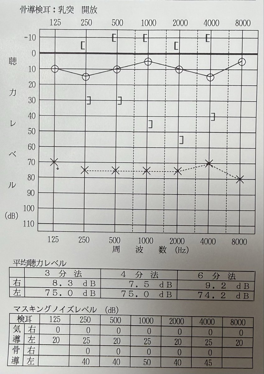 OtoLab_official's tweet photo. 数値を変えて掲載していますが、こんな感じのオージオグラムは世の中に溢れています。

診断もそうですが、これで補聴器の調整を行うのは、さすがに無理がありそうです。

(オペ適応があるか、ないならうちで補聴器やってみるよという紹介で、実際は感音難聴でした...。) https://t.co/DJpmHLV7ll