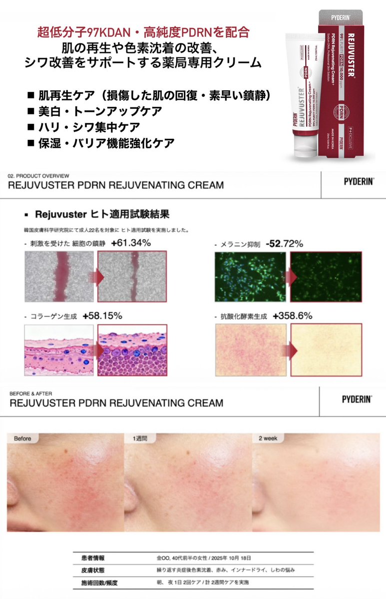 ちょっと長いんだけど、絶対知ってほしい本物のPDRN商品見つけたらぜひ読んで‼️

肌めっちゃ綺麗になるってバズってるこのPDRNクリーム、大学病院でも使われてるらしい。

韓国だと「医療グレードレベル」の広告表現に関する認証も取得してるみたい😱

2週間毎日使ってみての感想✍️
・皮膚科でLDM受けたみたいに調子良くなる
・ニキビ跡とか赤み明らかに薄くなってる
・毛穴の開きと黒ずみもマシになった

今じゃ色んなPDRN系の商品あるけど、本物買いたい人は原料規格まで見た方がよさそう。

私も最近知ったんだけど、「PDRN」「PN」って書いてあっても、化粧品の全成分ではどっちもDNA-Naって表記されるんだって⁉️
でも由来・分子量・純度・濃度まで同じとは限らないでしょ...

これを機に色んな商品見比べてみたけど、
このPYDERIN(ピデリン)のPDRNクリームがこだわりも成分もズバ抜けて凄かった。

・99% 韓国産の高純度PDRN
・97kDa超低分子PDRN
・10,000ppm(1%)高配合

商品名は「リジュブースター PDRN リジュビネイティング クリーム」だよ❗️  

【PR】【PYDERIN】