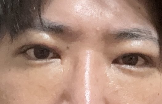 nDSiO1NeO2KzwhJ's tweet photo. @kankokuseikei_ 
LINK美容外科に行き裏ハムラ法とくまとりを行い1週間経ちました。
まだ違和感ありますが目が大きくなりました。 https://t.co/l0vKNF7zWT
