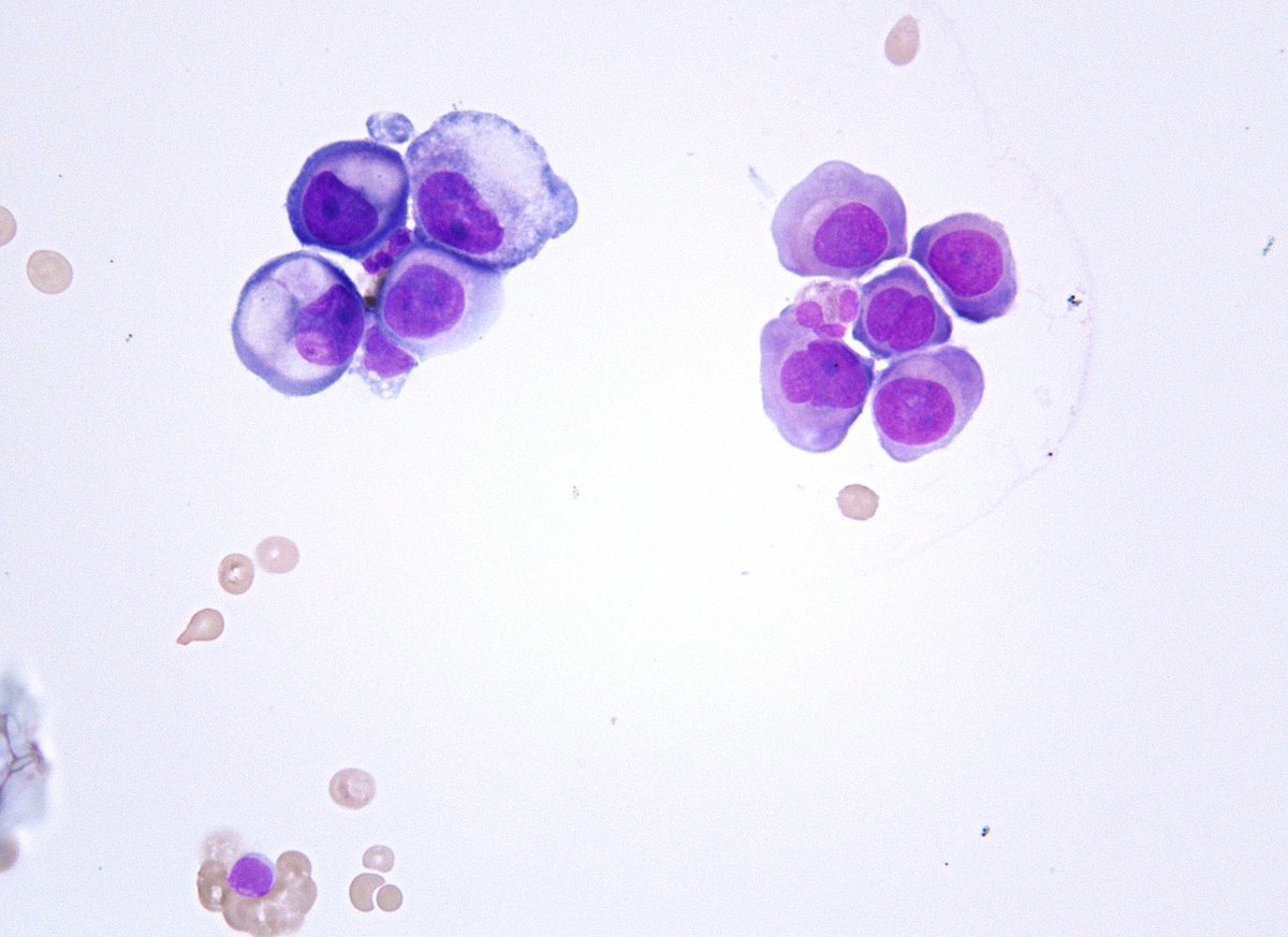 sza_jhcyto's tweet photo. “In CSF, size matters the most, especially when the nuclei look guilty.” Metastatic breast lobular carcinoma. (cytospin) https://t.co/DkHWiWv1DN