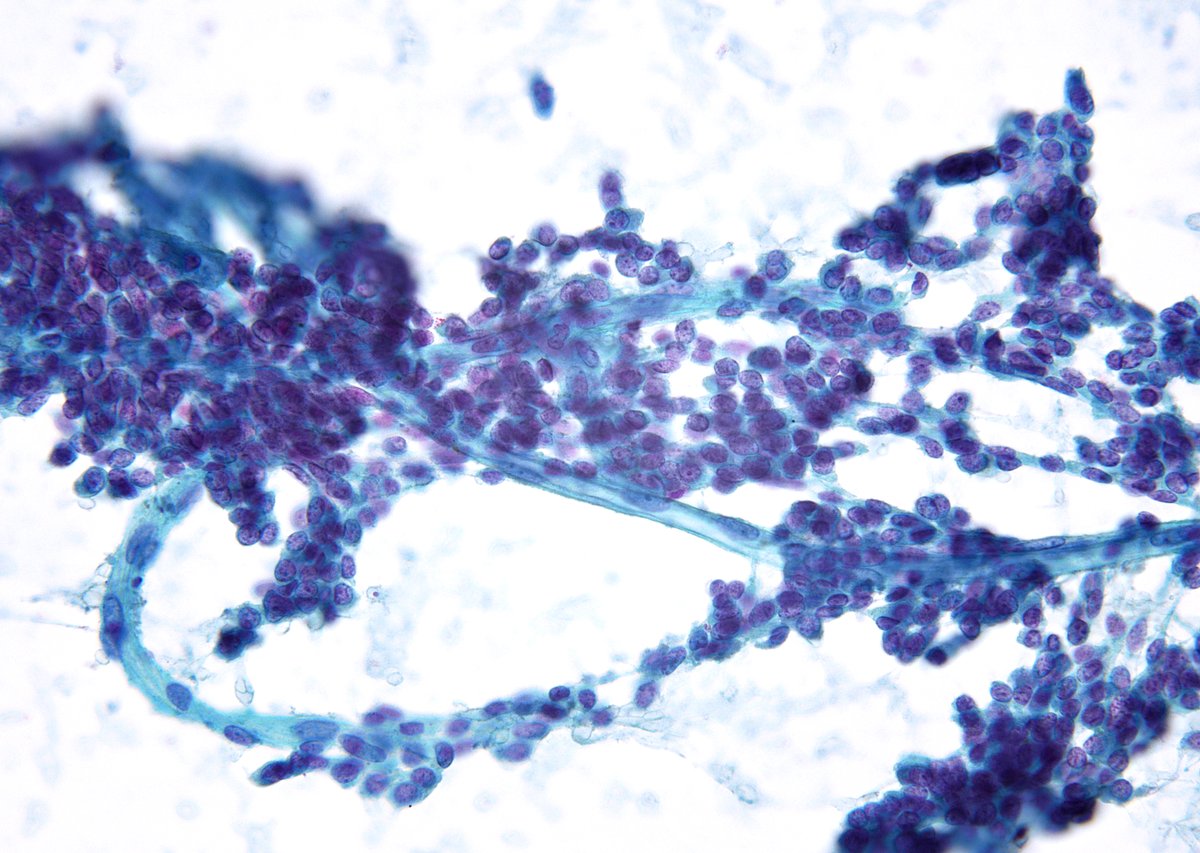 sza_jhcyto's tweet photo. “Where neuroendocrine cells gather, vessels are rarely far behind.” Metastatic NET from the gut on a liver FNA. https://t.co/eYaDavVUtD
