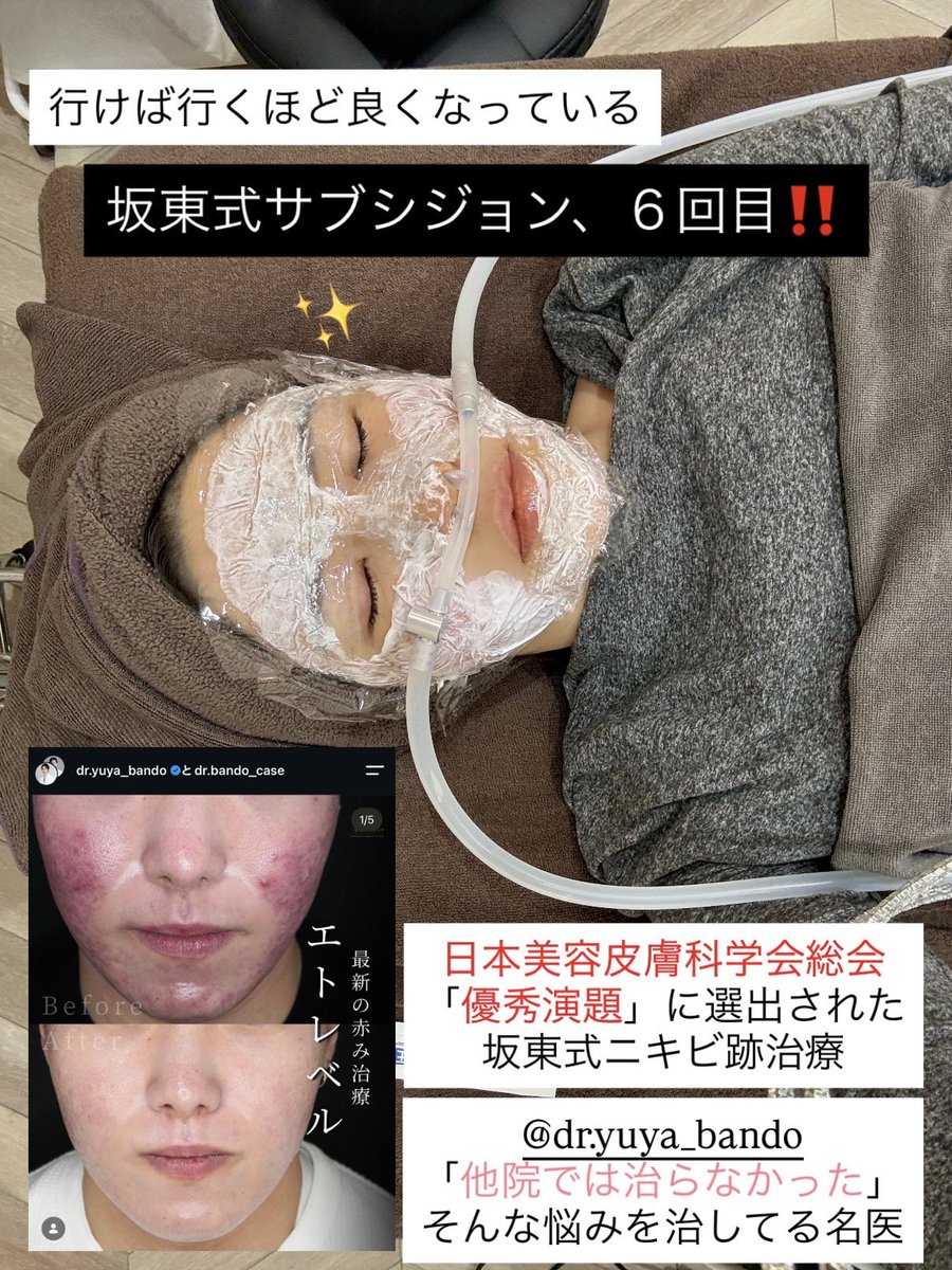 misachasu0209's tweet photo. 肌治療レポ：
日本美容皮膚科学会総会にて「優秀演題」に選出された、坂東式ニキビ跡治療。ジュベルックで良くならなかった「赤み」が消えた、一宮美容クリニック6回目の訪問。サブシジョン9回のガチ勢だけど、一宮激推し。行けば行くほど良くなる。飛行機・新幹線で通う価値が高い。しかも安い。

一宮美容クリニックに通い、気づけばもう6回目。

他院で頭打ちになっていたニキビ跡、クレーターが行けば行くほど良くなっている、最強のクリニック。

同院は、患者にとって"最後の砦”となる治療を目指している。

今回もいつものやつを、やっていただきました。

いつものニキビ跡治療：
サブシジョン＋キュアジェット（エトレベル）＋プルリアルリフレッシュ。

坂東式サブシジョン、Twitterで有名になってますが、最近は第44回 日本美容皮膚科学会総会にて坂東先生のニキビ跡治療の研究が「優秀演題」に選出。

普通のサブシジョンや、普通のニキビ跡治療じゃない。

ジュベルックではなくエトレベルで、
医学博士で大学病院元助教授の坂東先生の技術だから、だからこそ「効く」ニキビ跡治療。

同院のモットーは
「流行りの治療や機械（デバイス）治療をメインとするよりも、他院で治療に行き詰まった方が、他院でなかなか置いていない治療やデバイスを受けてもらい効果をだすことを大切に」とのこと。

肌治療ガチ民向け情報：
「努力ちゃん 23歳」 @rr47s4 が、私の投稿を見て、一宮美容クリニックに行って、サブシジョンとキュアジェットのレポをしてくれています。

詳しい施術内容レポ

一宮美容クリニックのレポがTwitterで増えて、坂東先生喜んでました！

https://t.co/E4dJjfwlpl
＞術後メイクしてるけど名古屋にある一宮美容クリニックでニキビ跡治療のサブシジョン（1回目）してからクッソ肌の調子が良い…😭

https://t.co/S0L27RSwQx
＞サブシジョンのプロだと思う。
1回で他人が見ても薄くなってるってわかるくらい効果あるから受けてよかった😭

https://t.co/ijD0Zrp1zJ
＞やっぱり一宮美容クリニックのサブシジョンすごい…！
めちゃくちゃ綺麗になられてて希望ありまくりですね！

…6回目の一宮美容クリニック、今回もしっかりやっていただき、だんだん良くなってる。

サブシを他院含め9回、他院では「頭打ち」になっていましたが、一宮美容クリニックは行けば行くほどちゃんと良くなるから本当に嬉しい。

一宮美容クリニック、名古屋市の隣の一宮市（名古屋駅から10分）で家賃が安いからか、費用がリーズナブル。

医学博士で元助教授、坂東先生の高い技術力の治療が、リーズナブルに受けられる、しかも、ふるさと納税まで使える、穴場クリニックです。

忖度なく、新幹線に乗ってでも費用対効果が高い。

プルリアルリフレッシュ：
↑追加するようになってから、ダウンタイム短縮され感動。
同院オリジナル組成で、どのクリニックにもあるプルリアルデンシファイのような短期で現れる爆発的な艶感というよりは長期的に肌の土台を整え直すイメージらしい。
量も6ccと他の製剤よりも多く、全顔＋首まで施術してもらえてかなりお得。

ジュベルックとエトレベルの違い💉：
（ChatGPTより）

・どちらもPDLLA（コラーゲン誘導製剤）
・ジュベルック＝粒子が細かく、肌質改善・赤み改善寄り
・エトレベル＝粒子がやや大きく、構造再建・深い瘢痕向き

ジュベルックは“面で整える再生”、
エトレベルは“土台から支える再建”。

“優しめ再生”か“しっかり再建”かの違い。

坂東先生は「エトレベル」の日本の第一人者。

肌治療ガチ勢の私が
施術効果を最大化するためにやってる事リスト
https://t.co/XVy4ptAGHE

私のオススメ名古屋グルメ10選
https://t.co/MwRB4CgRqi
治療のついでにいかがでしょうか。

この情報が、肌で悩む方のお役に立てたら嬉しいです。

※投稿で反響があったので、サービスしていただいてます。ステマとかになってはいけないので明記。
飛行機で通う、穴場クリニックです。 https://t.co/lKrTrTBAyw