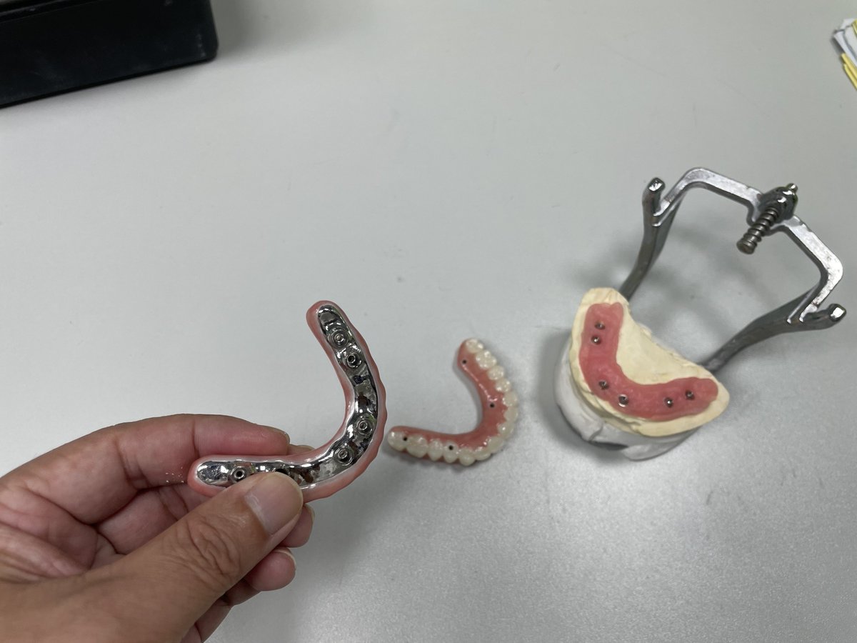 jackwangzixiao's tweet photo. If the price of All-on-X continues to drop, will it completely replace full dentures? https://t.co/MyaA4b2SjG