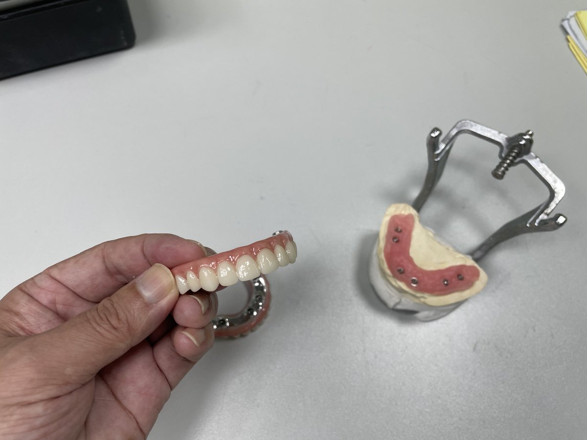 jackwangzixiao's tweet photo. If the price of All-on-X continues to drop, will it completely replace full dentures? https://t.co/MyaA4b2SjG