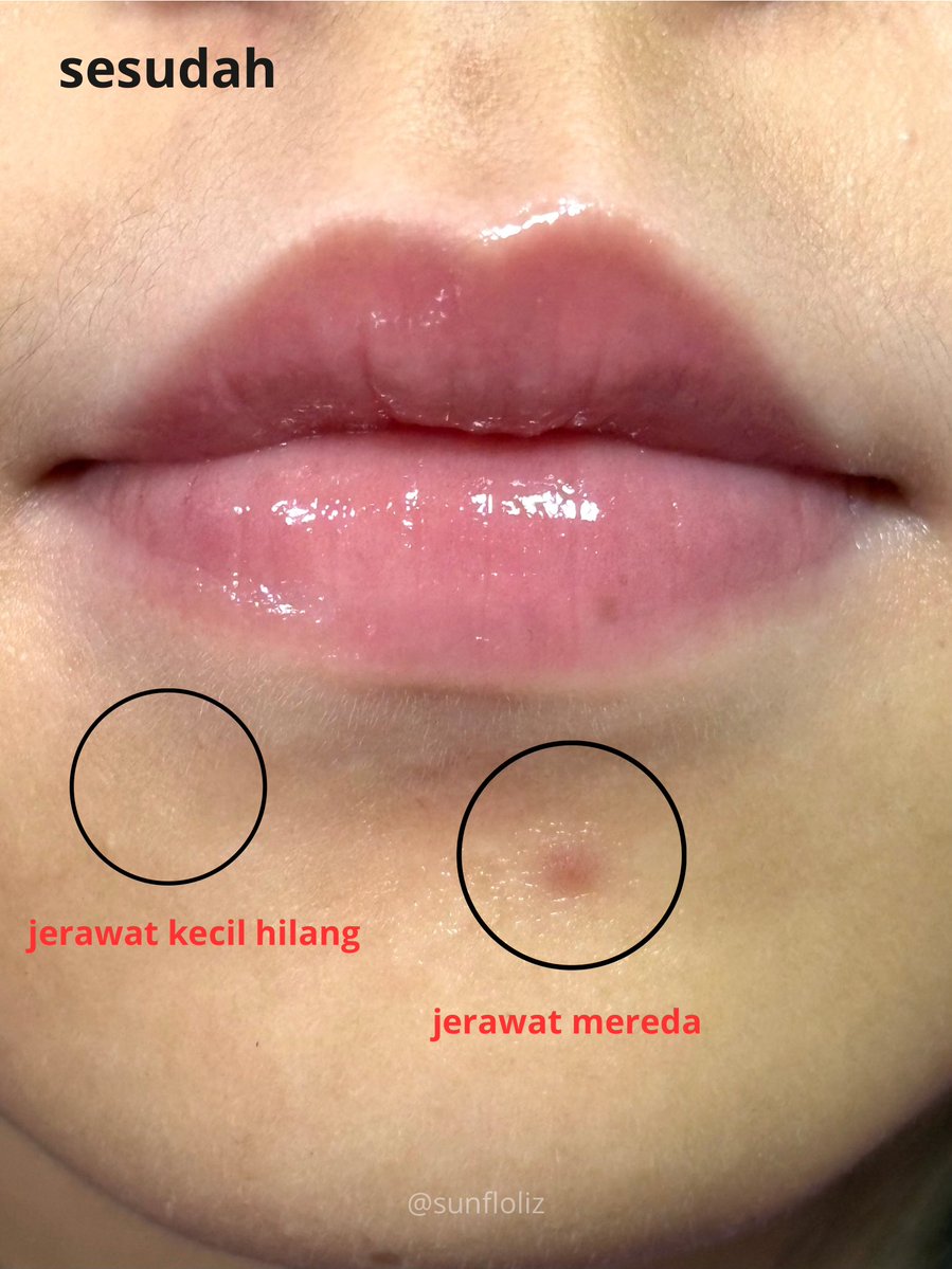sunfloliz's tweet photo. nemu skincare murce tapi gong in this economy tuh such a blessing sih 🥹

liat deh, baru semingguan tapi jerawat aku udah lebih mendingan gak sih?? the real acne monster game over sih 👏 https://t.co/Yqs2IqWX2c