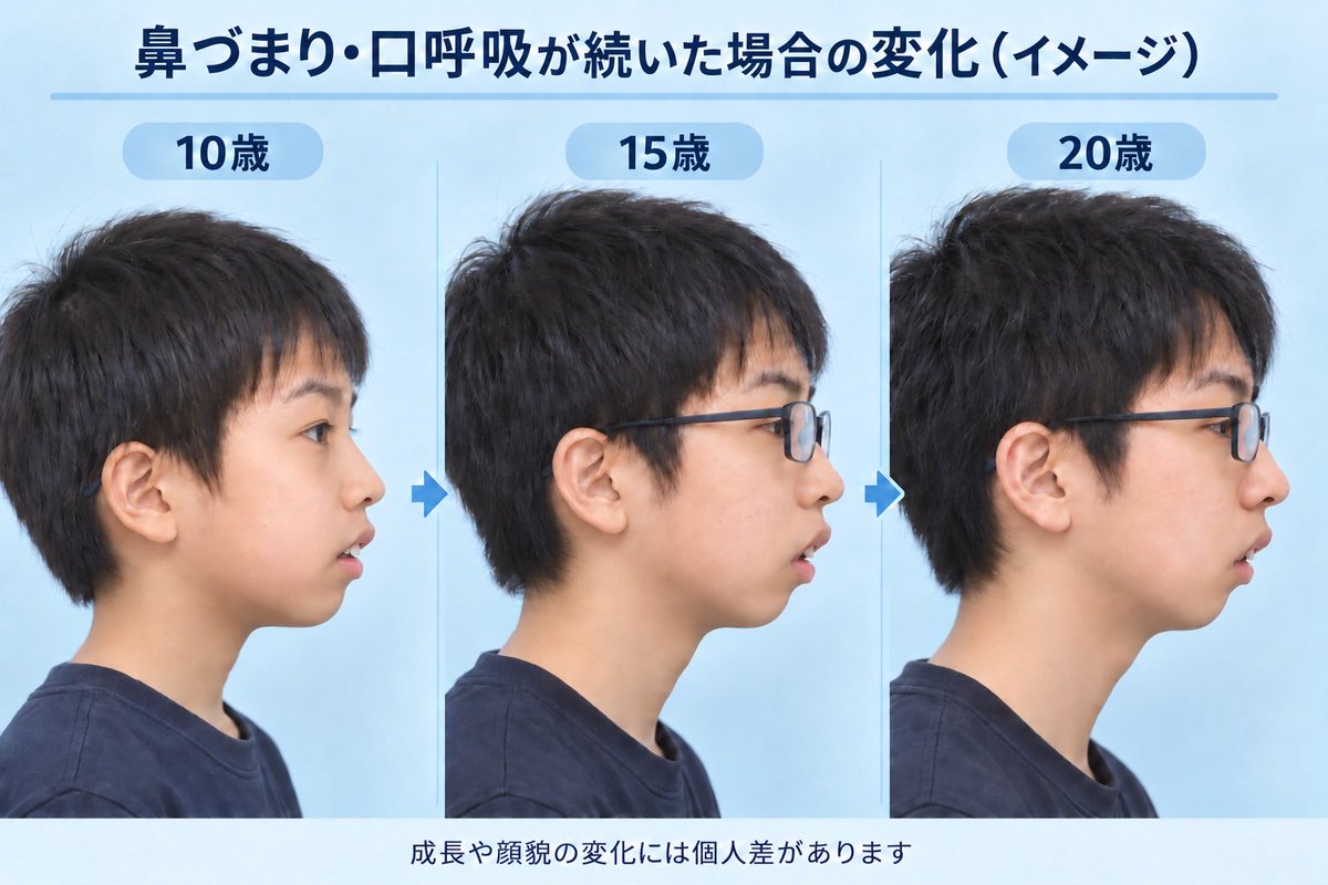 seikeinu's tweet photo. 幼少期から口呼吸してた人の特徴

・アゴ後退し口ゴボ
・歯並びガタガタ
・口渇き菌だらけで息がくさい
・虫歯になりやすい
・滑舌が悪い
・いびきがうるさい
・唇が厚くめくれ上がっている

電車で見る人3割これ。申し訳ないけど正直すごく頭悪そうに見えるしデメリット多すぎなので身に覚えがある人は今すぐ口閉じてください。また、お子さまの口が開いてたらすぐ閉じさせてください。ブスまっしぐらです。
興味ある人はアデノイド顔貌で調べると詳しい情報出てきますよ。