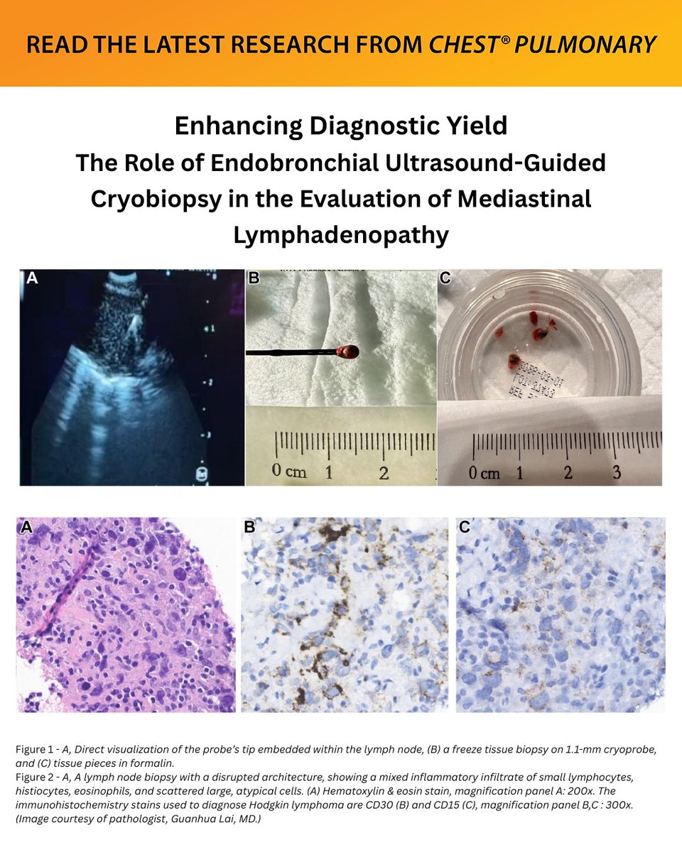 journal_CHEST's tweet photo. Enhancing Diagnostic Yield: The Role of Endobronchial Ultrasound-Guided Cryobiopsy in the Evaluation of Mediastinal Lymphadenopathy
Read more: https://t.co/80GE1evO9S
#MedEd #JournalCHEST #Journal_CHESTPulm https://t.co/DA4tOgenmF