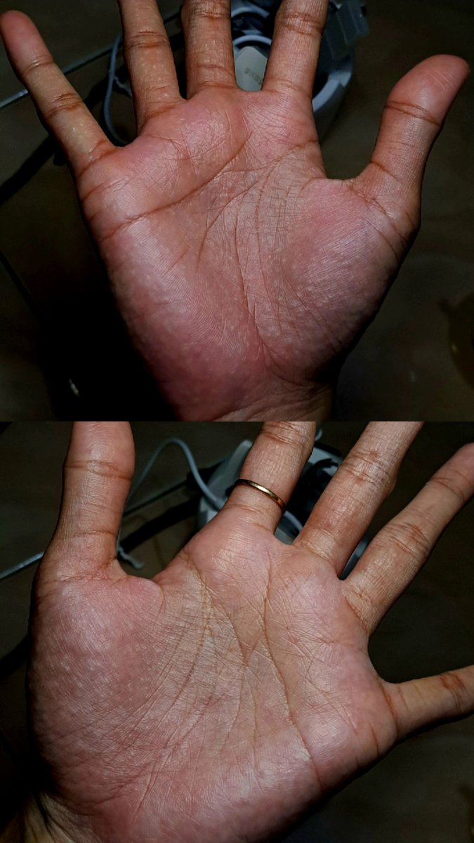 Senjaniuu's tweet photo. @TanyarlBase Kemarin aku juga gini nder, ini paling parah, telapak kaki juga. Biasanya padahal cuma telapak kaki sebelah. Setelah aku cari tau ternyata yang kali ini karena gak cocok sama sabun.
Kemarin kukompress pake NaCl 0,9%, sama pake salep dari halodoc, seminggu sembuh. https://t.co/yZmhts49FV