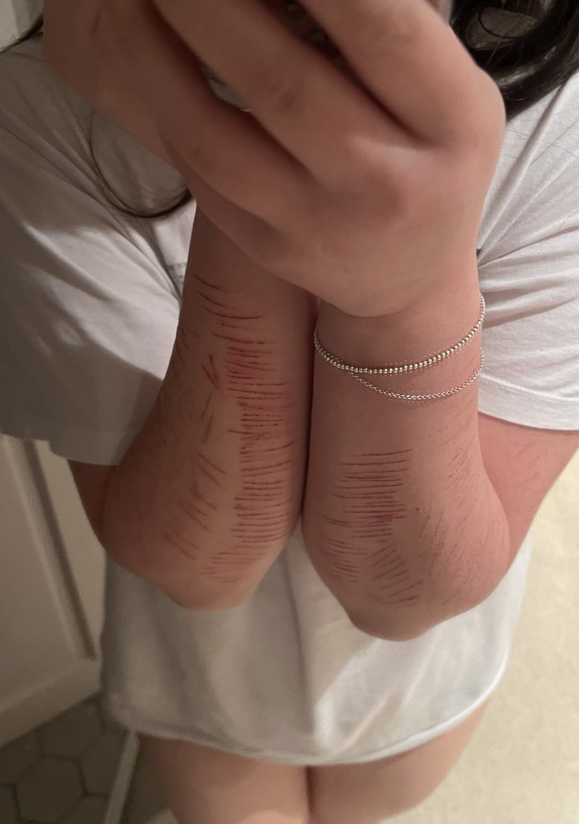 frostbit3s's tweet photo. I miss these pretty cat scratches from last winter ��� https://t.co/7Hzjtm8B1C