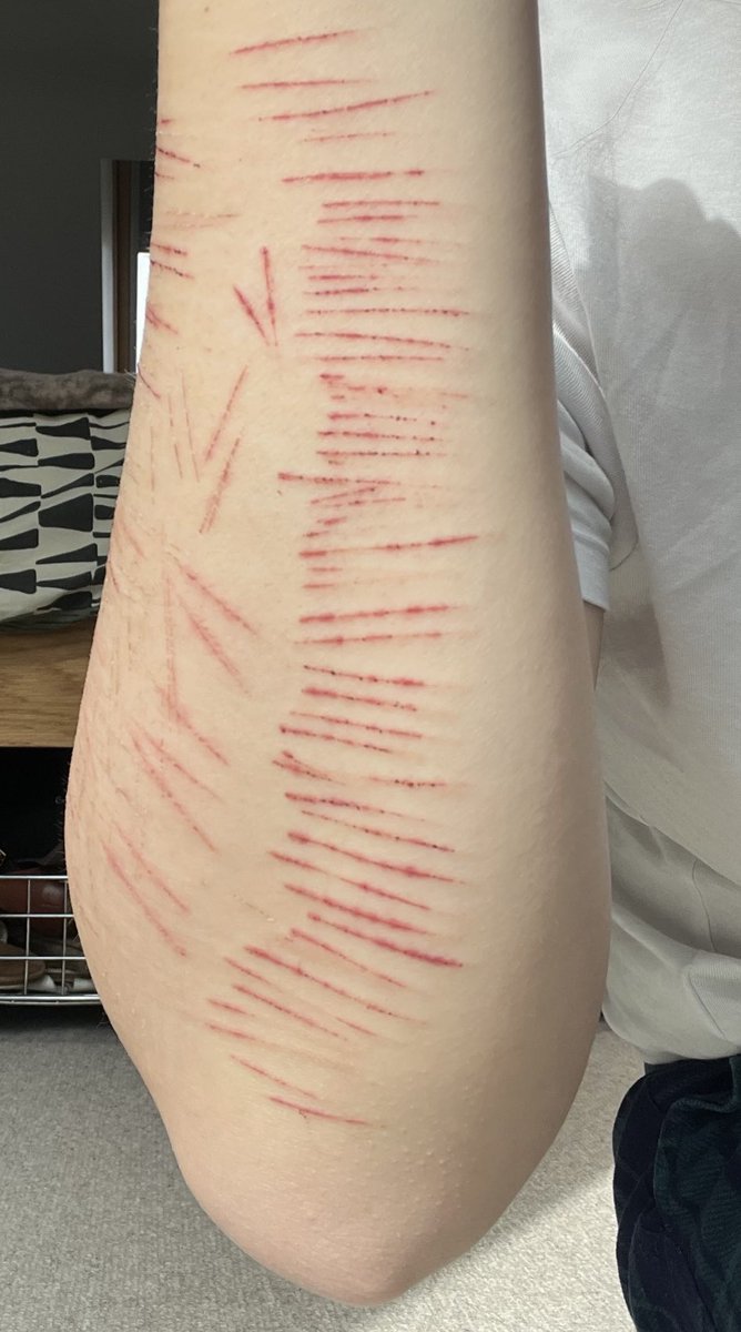 frostbit3s's tweet photo. I miss these pretty cat scratches from last winter ��� https://t.co/7Hzjtm8B1C
