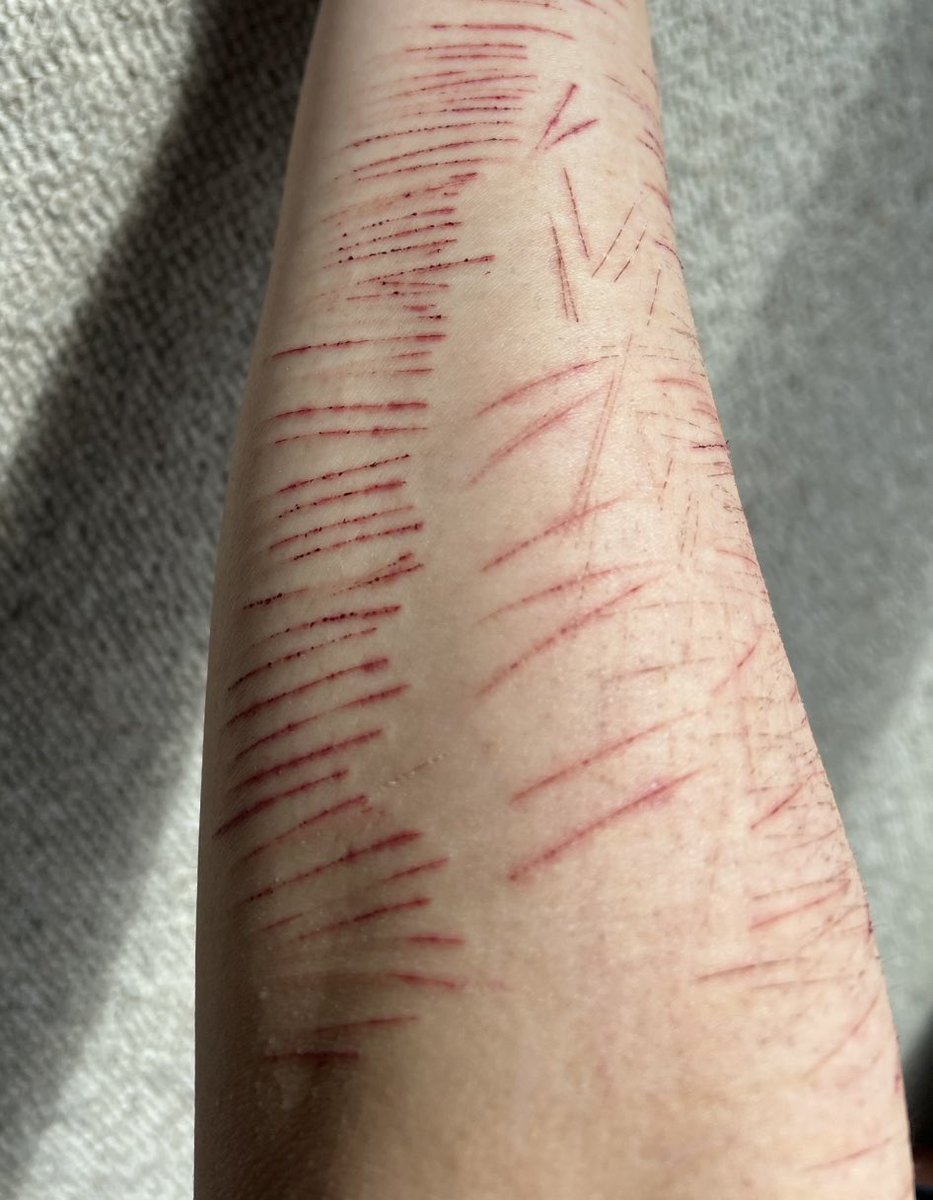 frostbit3s's tweet photo. I miss these pretty cat scratches from last winter ��� https://t.co/7Hzjtm8B1C
