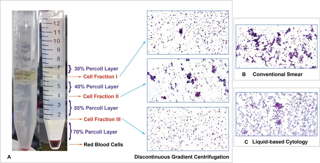 ArchivesPath's tweet photo. Is there a better alternative for preparing pleural fluid for the detection of malignant pleural 
effusions? 

Find out here 👉 10.5858/arpa.2025-0442-OA

#CAP #Archives #Pathology #Cytopathology #Cytology https://t.co/UYXUv23vPq