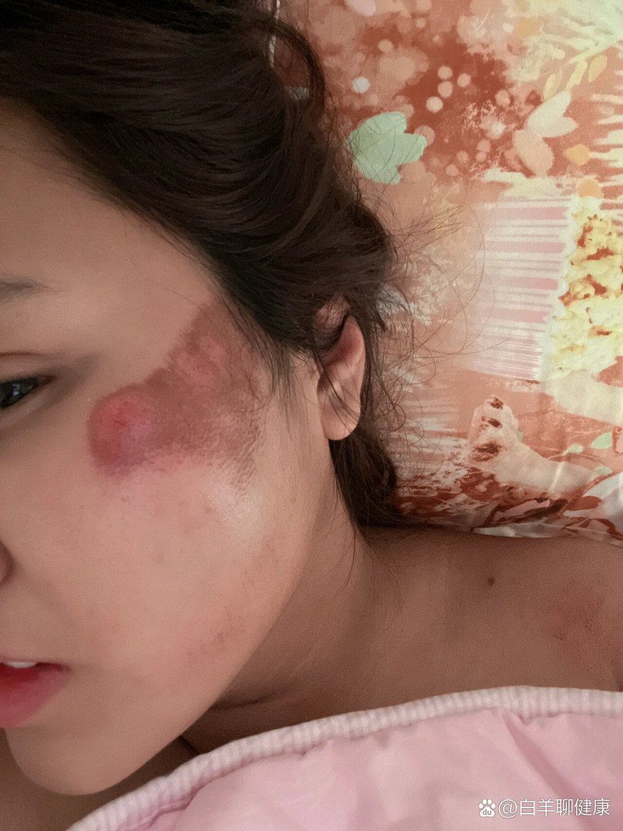 Muhamma62183643's tweet photo. [Oops, I bumped my face into the door and now there's a swollen cut on my cheek. Ugh, that's so painful!]， https://t.co/RSTNwy1uBx
