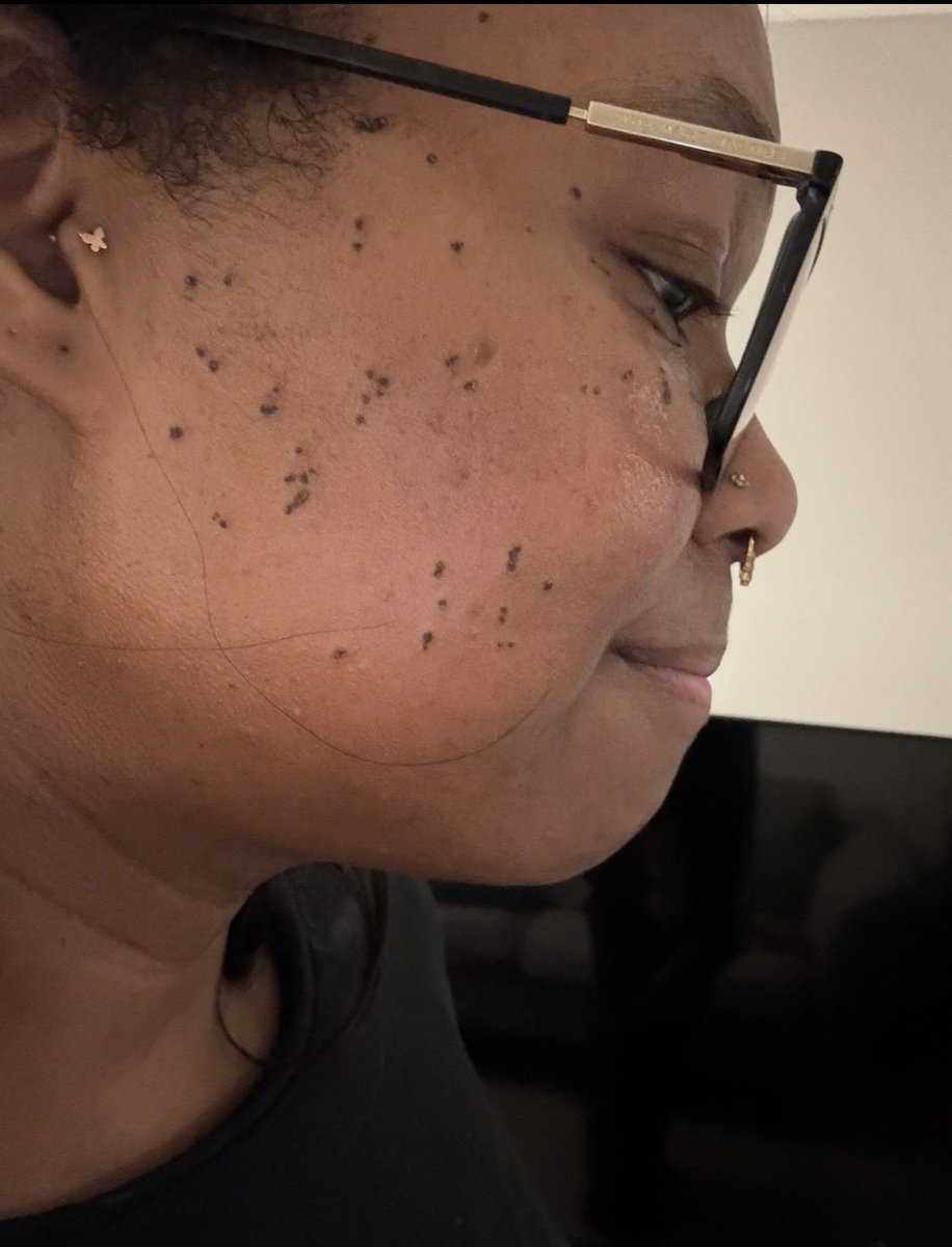 RoseGold_Ranger's tweet photo. Don’t let anyone tell you getting #DPN #DPNRemoval is painless. This shit HURT. #DermatosisPapulosaNigra https://t.co/oXh0hH7Vfb