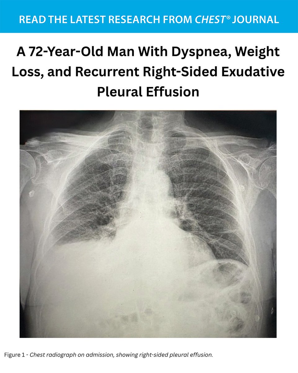 journal_CHEST's tweet photo. A 72-Year-Old Man With Dyspnea, Weight Loss, and Recurrent Right-Sided Exudative Pleural Effusion
What's the diagnosis? Read the full CHEST Pearl in the September issue of the journal CHEST®: https://t.co/BD4NuHYXV8
#MedEd #JournalCHEST https://t.co/gX5vDEdypo