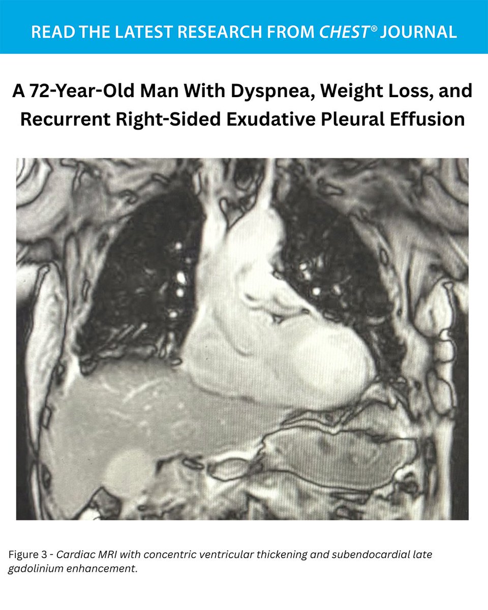 journal_CHEST's tweet photo. A 72-Year-Old Man With Dyspnea, Weight Loss, and Recurrent Right-Sided Exudative Pleural Effusion
What's the diagnosis? Read the full CHEST Pearl in the September issue of the journal CHEST®: https://t.co/BD4NuHYXV8
#MedEd #JournalCHEST https://t.co/gX5vDEdypo