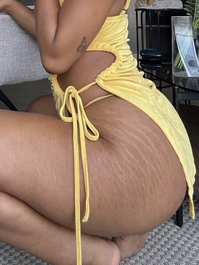 gxhhdkkk's tweet photo. Do you find stretch marks attractive? https://t.co/NQzzPowvUb