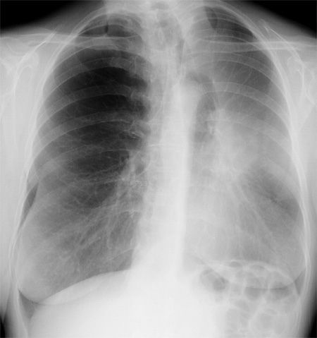 RadMasterclass's tweet photo. CHEST X-RAY 30: Cough, shortness of breath, weight loss, smoker. What is the radiological abnormality and what is the likely underlying cause? Answer https://t.co/R8e7NQsRiS https://t.co/zNSsDBAXq5