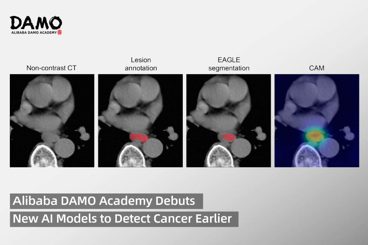 AlibabaGroup's tweet photo. Alibaba DAMO Academy has unveiled new AI models to advance early cancer detection and tackle critical global health challenges.  

DAMO EAGLE, designed for the early detection of esophageal cancer, expands DAMO’s suite of cancer detection models, which already cover pancreatic, gastric, colorectal, and liver malignancies. 

DAMO RADAR, a generalist medical imaging AI model, is capable of identifying 146+ conditions from a single CT scan, marking a breakthrough in multi-disease abdominal detection.