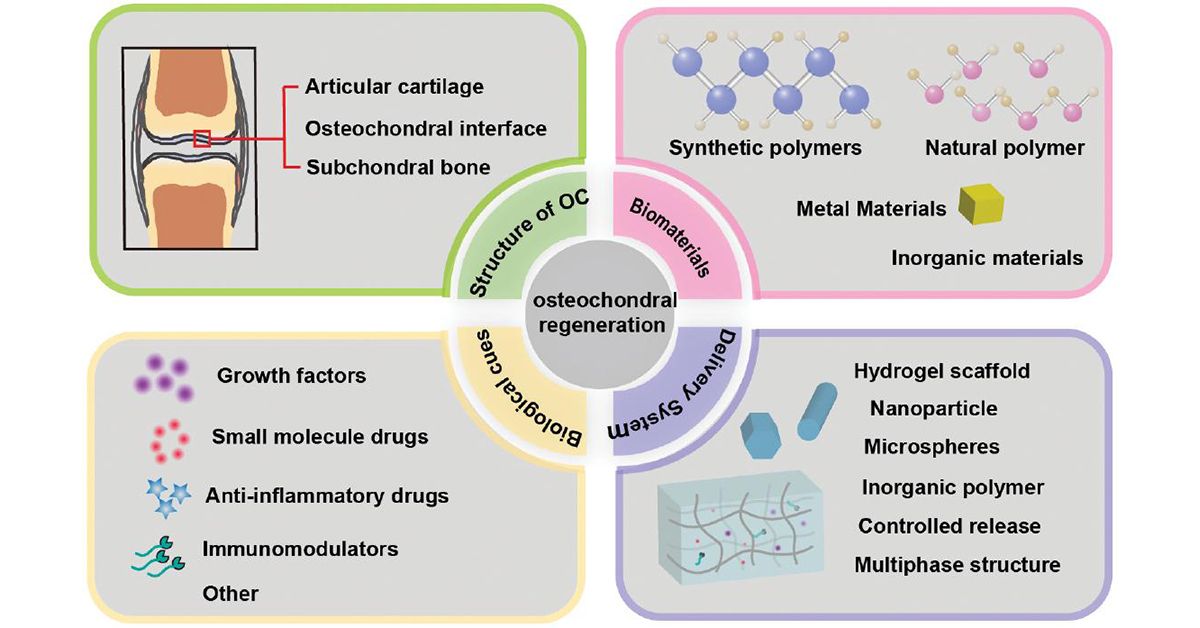 JournalBio's tweet photo. Can biomaterials solve cartilage drug delivery?
This review highlights systems that penetrate cartilage, bind ECM, and sustain drug pools, advancing osteochondral regeneration. #Orthopedics #Biomaterials #Osteochondral
#BIOI #OpenAccess: https://t.co/PvvXdvHy9x https://t.co/pfy9Go6hHG
