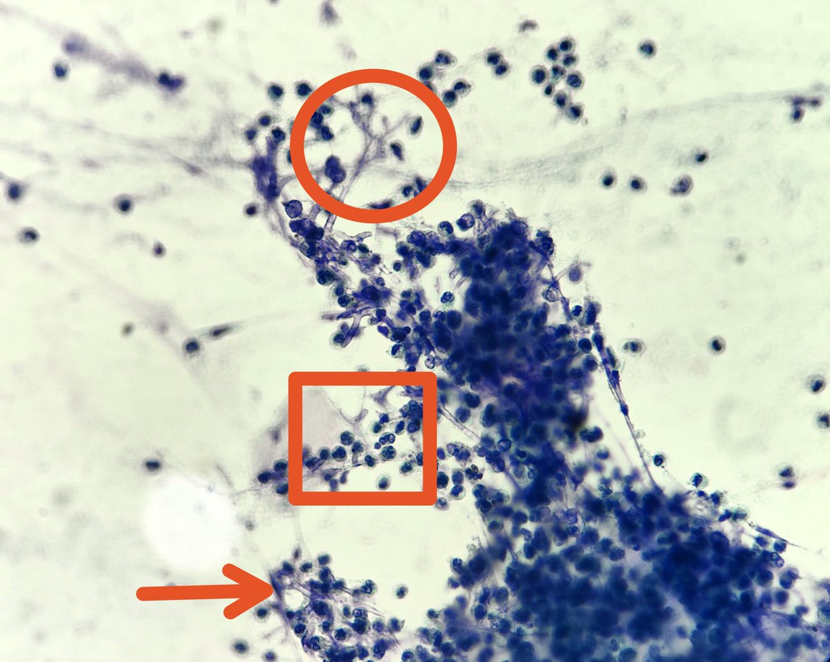 padmapathology1's tweet photo. Case of non-responding pneumonia 

Acute angled branching septate hyphae, surrounded by neutrophils in bronchial washing.

🔺Aspergillus

Image 2 shows negative image of the fungus in AFB staining 

#cytopath
#IDpath
#pulmpath
#pathtwitter
#pathresidents 
#Pathology https://t.co/3f7636ut3Q