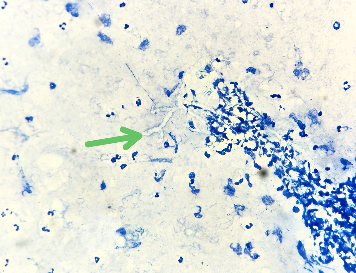 padmapathology1's tweet photo. Case of non-responding pneumonia 

Acute angled branching septate hyphae, surrounded by neutrophils in bronchial washing.

🔺Aspergillus

Image 2 shows negative image of the fungus in AFB staining 

#cytopath
#IDpath
#pulmpath
#pathtwitter
#pathresidents 
#Pathology https://t.co/3f7636ut3Q