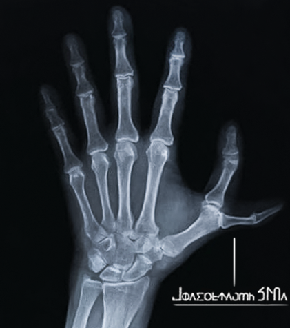 An X-ray image of a human hand showing the bones and joints clearly against a dark background, with some upside-down text visible at the bottom.