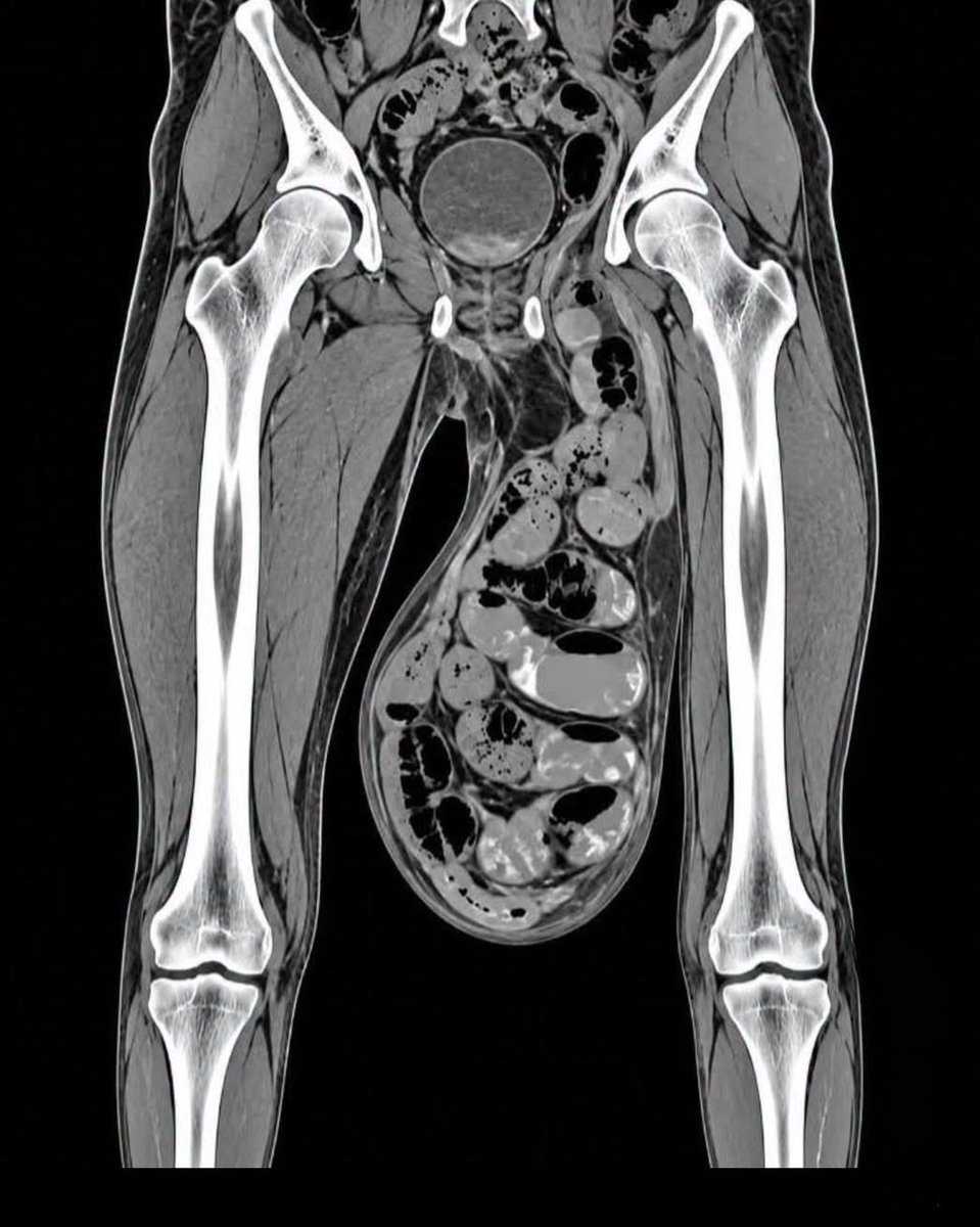 dromr__'s tweet photo. أمس رأيت أشعة لشاب تظهر كيس الصفن (Scrotum) متمدد بشكل مخيف مثل ما ترون.

هذا الشاب رياضي٫ ياكل كل شي صحي٫ ليس عنده أي مرض أدى لها أو ورم.

لكنه كان يفعل عادة واحدة خبيثة أدت إلى نزول الخصيتين وتمددهم بهذا الحجم٫ العادة كانت: https://t.co/oD8f9xy1lg