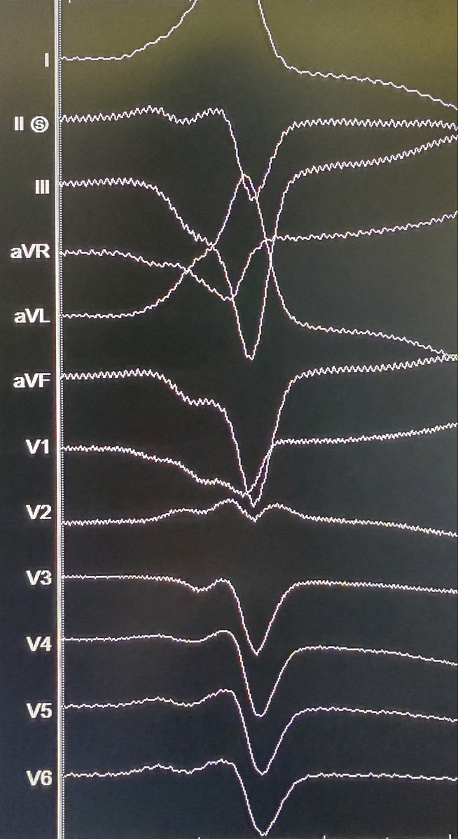 sumitvermaep's tweet photo. Basal Crux PVC ablated from the proximal MCV. “Reverse pattern break” in V2 @slate11p @AbbottCardio https://t.co/N5mpLqGH2F