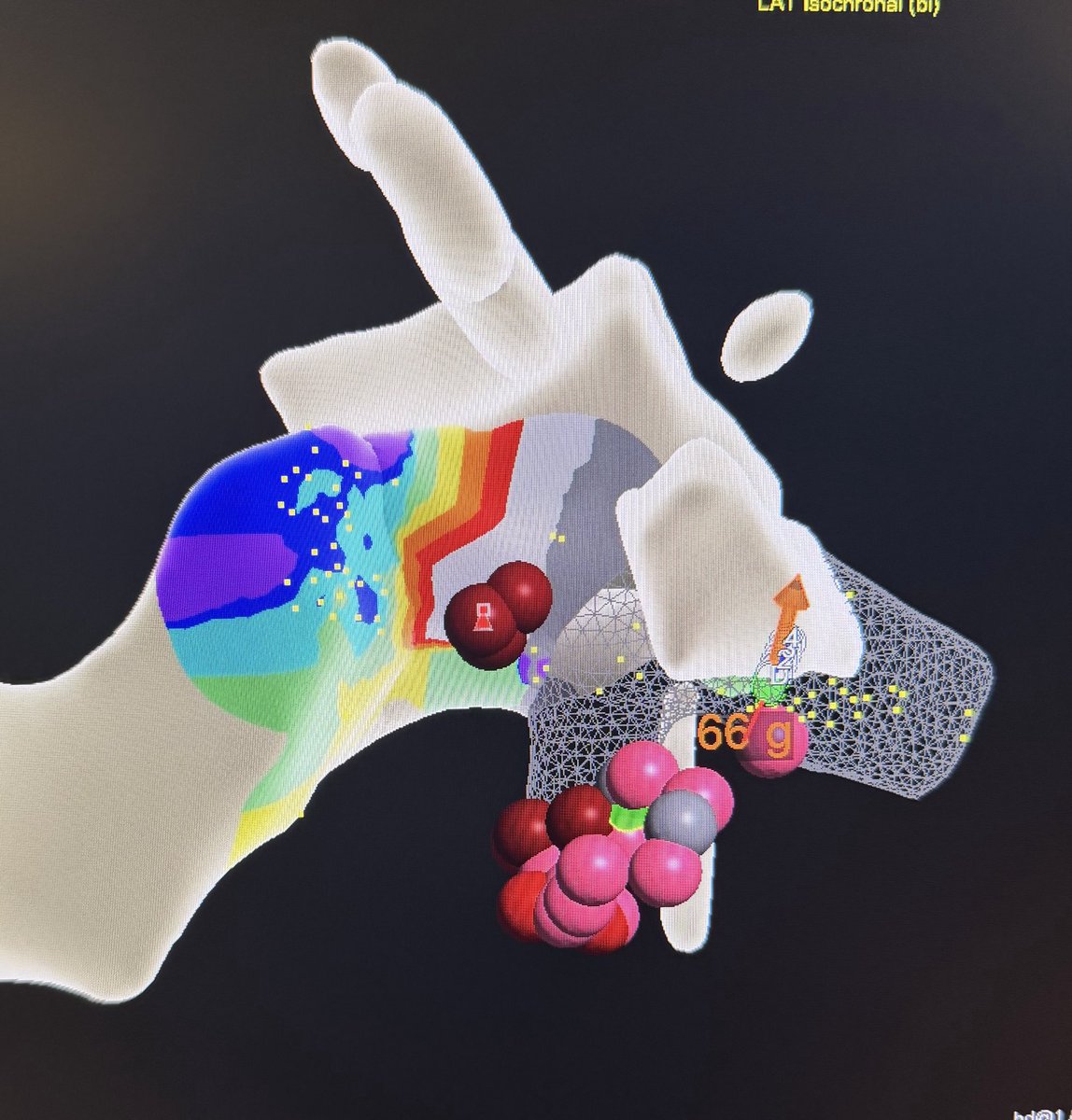 sumitvermaep's tweet photo. Basal Crux PVC ablated from the proximal MCV. “Reverse pattern break” in V2 @slate11p @AbbottCardio https://t.co/N5mpLqGH2F