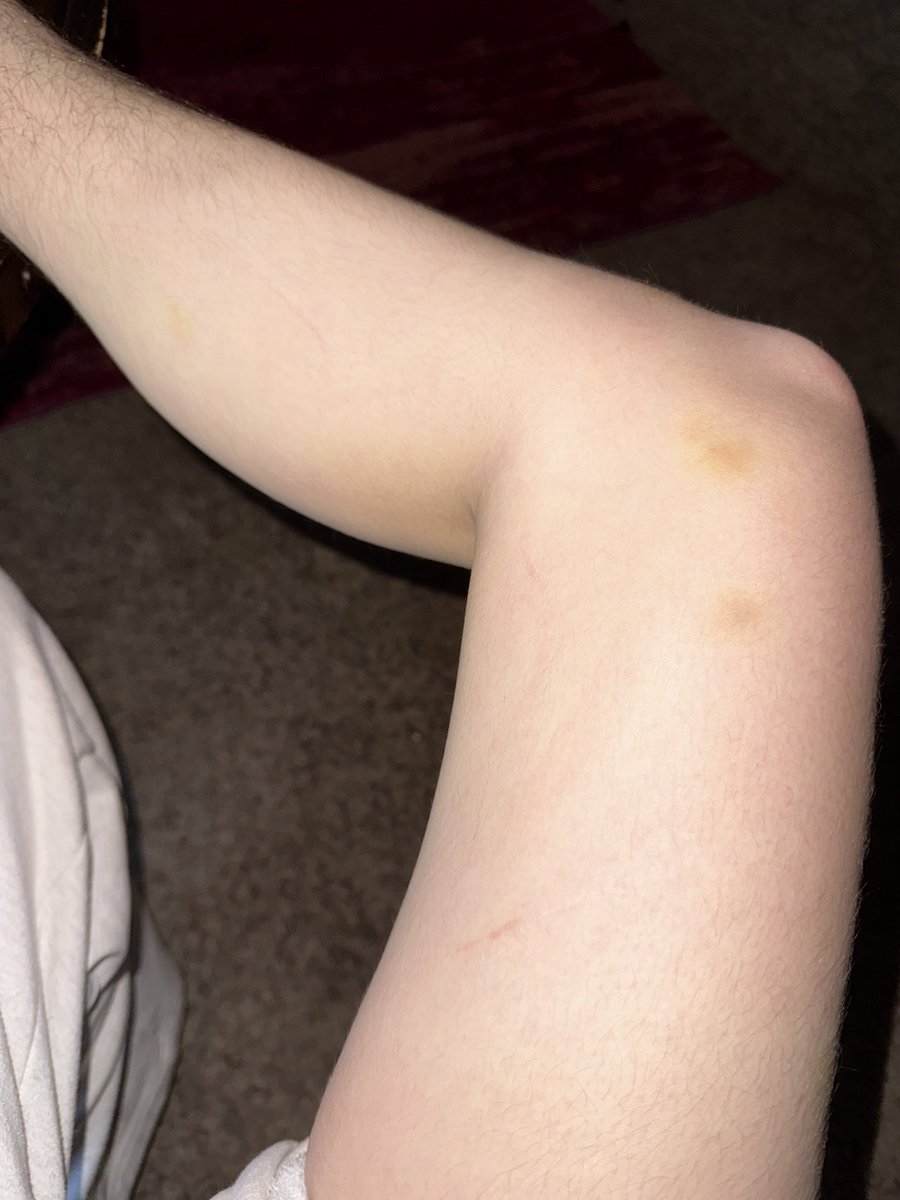 VicariousBliss's tweet photo. My fucker up foot and leg (the only sources of pain i can recall are that i dropped two bedframes on my foot and ankle, and my calves both hurt from a concert) https://t.co/KZT4Gw7p5c